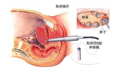 男性不育的病因有几类，能不能通过第二代试管婴儿解决