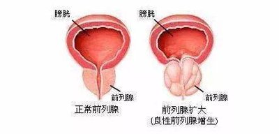 有这几种情况需警觉宫腔粘连,可以进行佛山试管婴儿移植吗