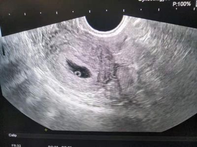 珠海试管移植后怀孕的准妈妈该怎么才能保持睡眠质量